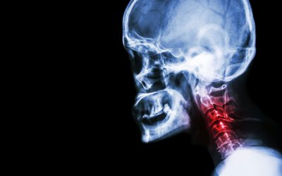 Can A Car Accident Cause Spondylosis?